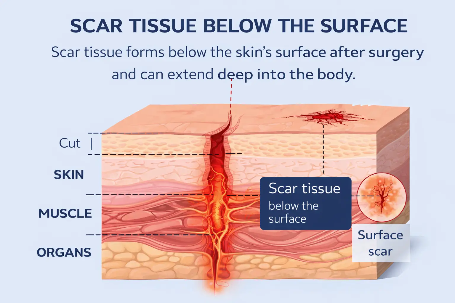 Diagram showing how surgical scar tissue adhesions restrict movement and cause pain