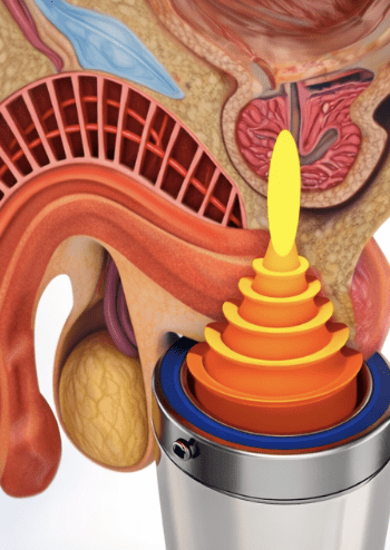 Focused shockwave therapy for chronic pelvic pain syndrome (CPPS) - treatment illustration