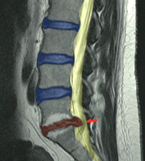 Lumbar disc herniation MRI scan showing spinal disc injury commonly treated with vertebral axial decompression therapy