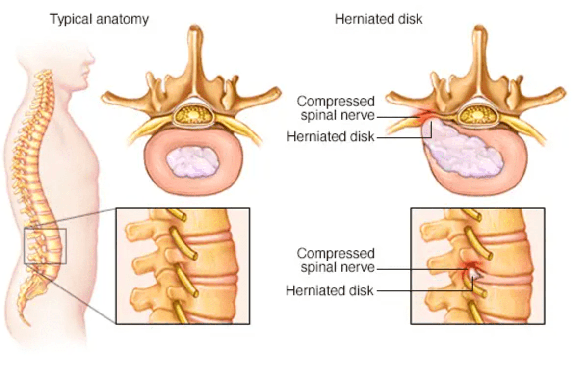 Herniated disc and compressed spinal nerve diagram showing conditions treated by vertebral axial decompression therapy after car accidents