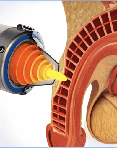 Focused shockwave therapy for erectile dysfunction - treatment illustration