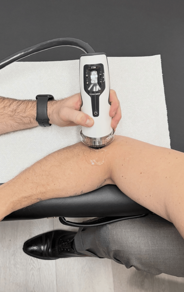 Focused shockwave therapy applied to the lateral epicondyle for tennis elbow relief
