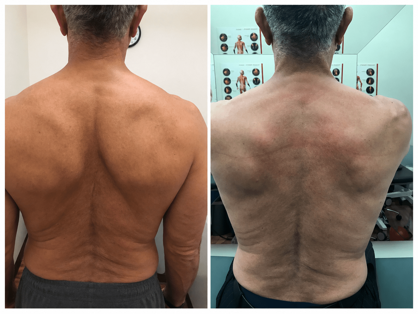 Before and after &mdash; postural correction at CityIR