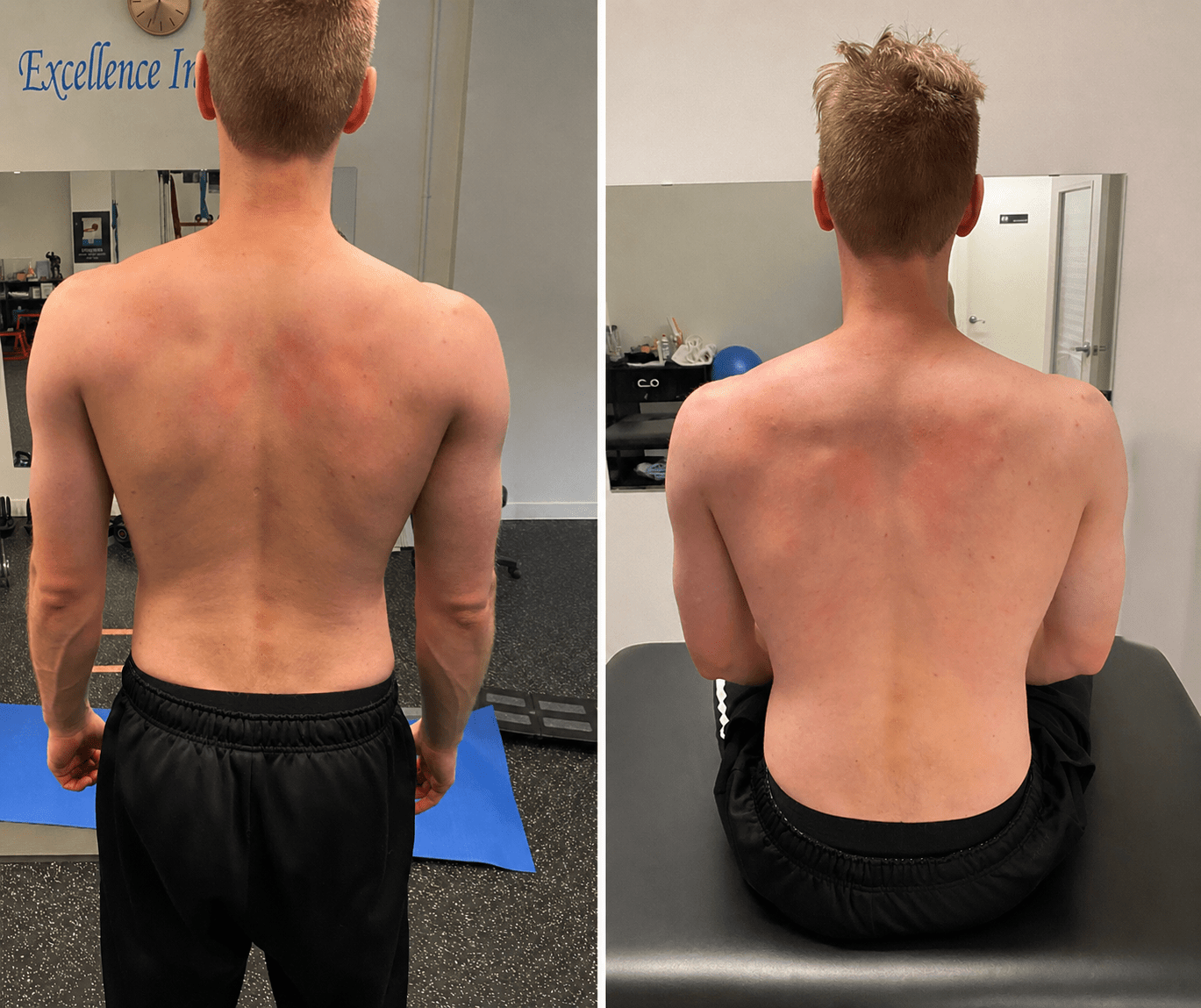 Before and after &mdash; scapular and spinal alignment at CityIR