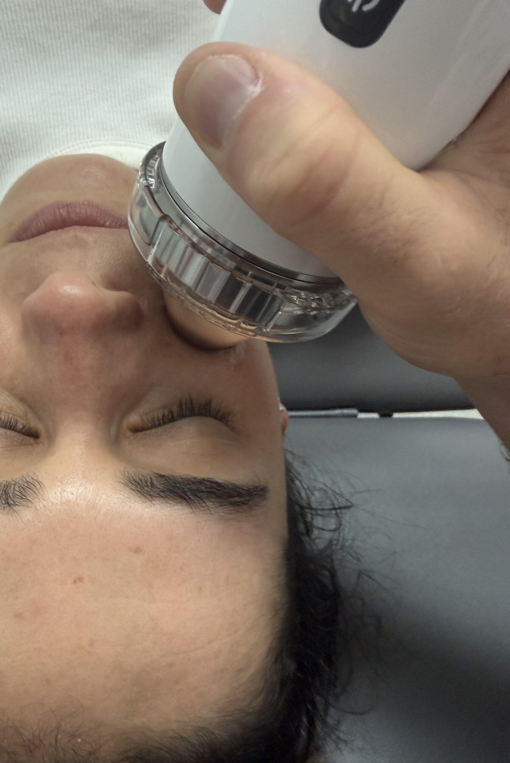 Facial shockwave therapy — the Notox facial