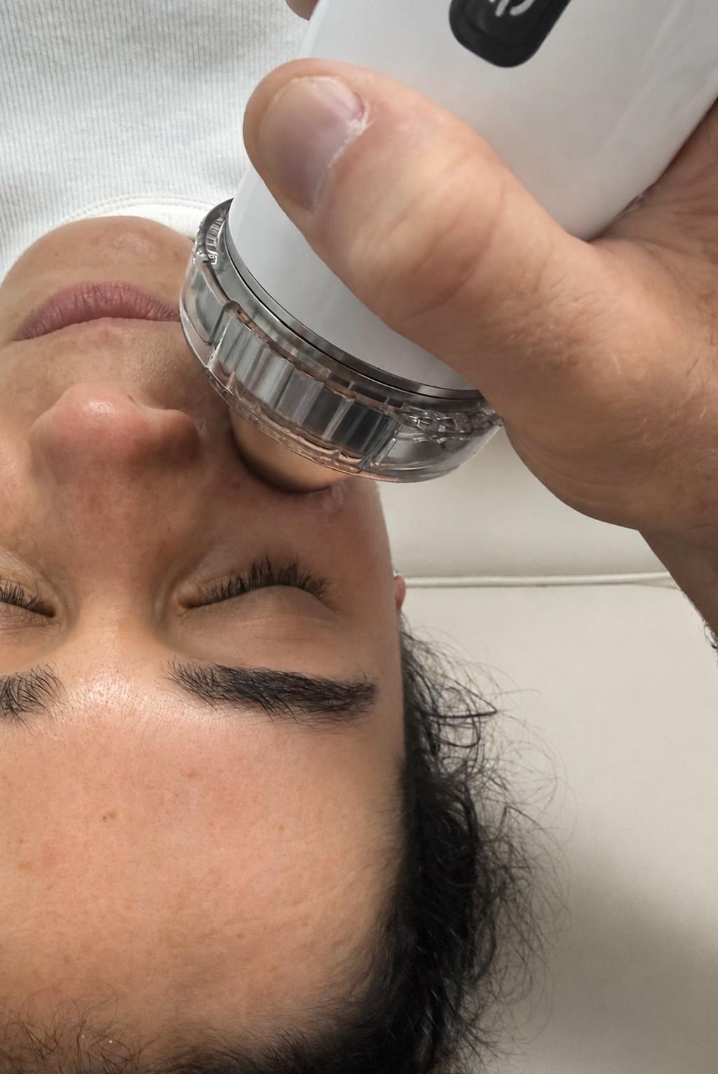 Facial shockwave therapy — the Notox facial